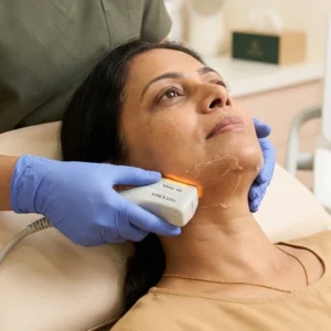 HIFU - Face & Neck in Bangalore Clinical Assessment & Treatment - Dermis 365 Bengaluru