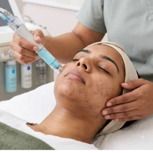 HydraFacial - Anti-Acne in Bangalore Clinical Assessment & Treatment - Dermis 365 Bengaluru