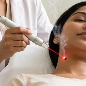 Laser Mole Removal in Bangalore Clinical Assessment & Treatment - Dermis 365 Bengaluru