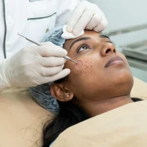 Punch Excision - Acne Scars in Bangalore Clinical Assessment & Treatment - Dermis 365 Bengaluru