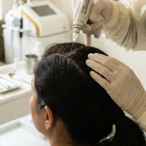 Scalp Mesotherapy in Bangalore Clinical Assessment & Treatment - Dermis 365 Bengaluru