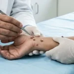 Skin Tags Clinical Assessment & Treatment - Dermis 365 Bengaluru