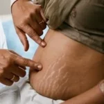 Stretch Marks Clinical Assessment & Treatment - Dermis 365 Bengaluru