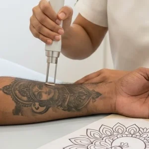 Tattoo Fading - Cover-Up Prep in Bangalore Clinical Assessment & Treatment - Dermis 365 Bengaluru