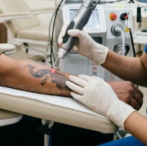 Tattoo Removal Clinical Assessment & Treatment - Dermis 365 Bengaluru